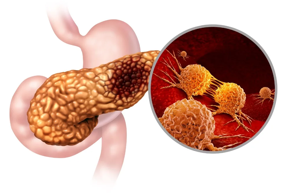 What Is Pancreatitis and Its Types
